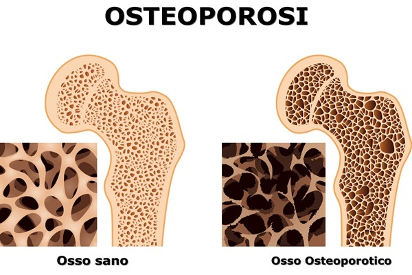PATOLOGIE GERIATRICHE E APPROCCIO OSTEOPATICO: tmp1FDD Osteoporosi GVM festa della donna -